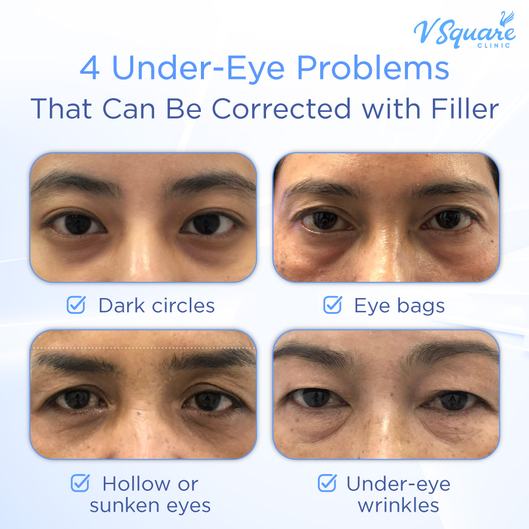 4ปัญหาใต้ตา