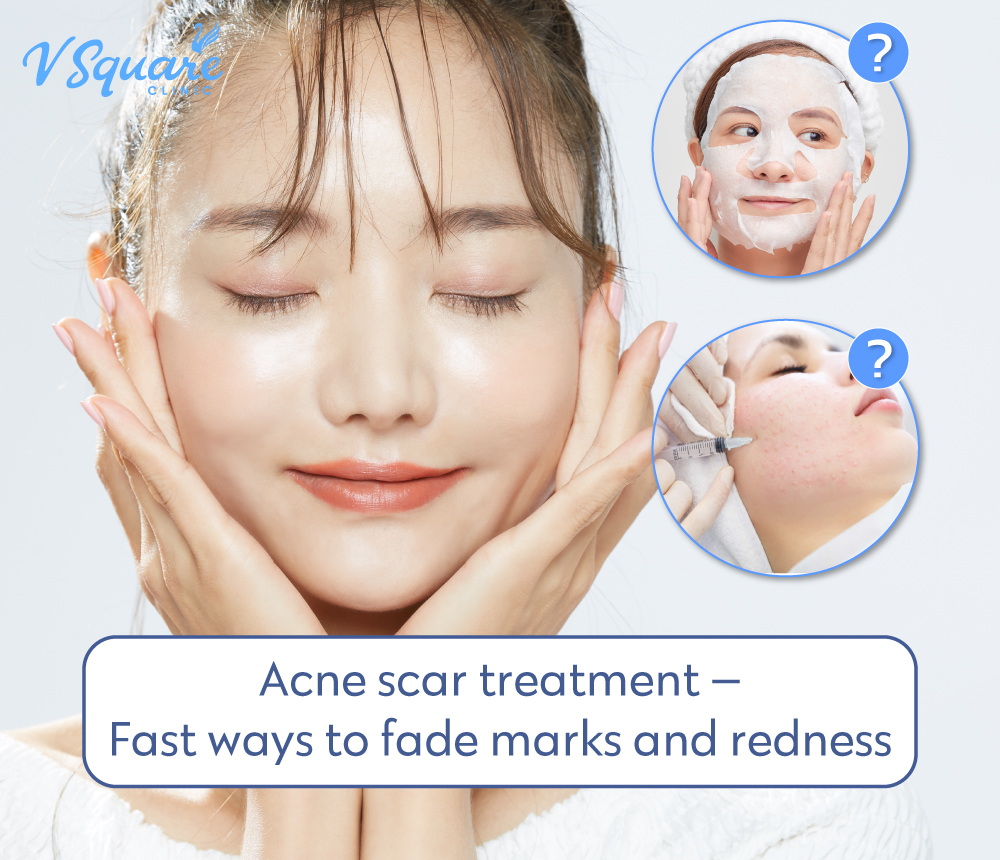 Acne scar treatment
