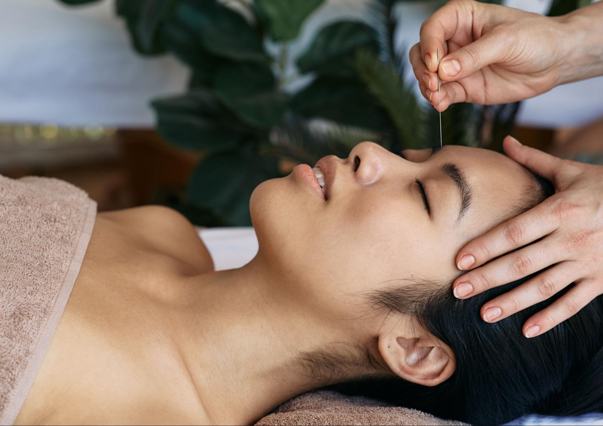 Acupuncture for migraine relief