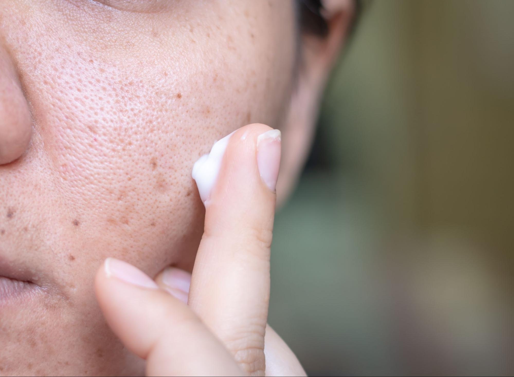 Applying dark spot cream