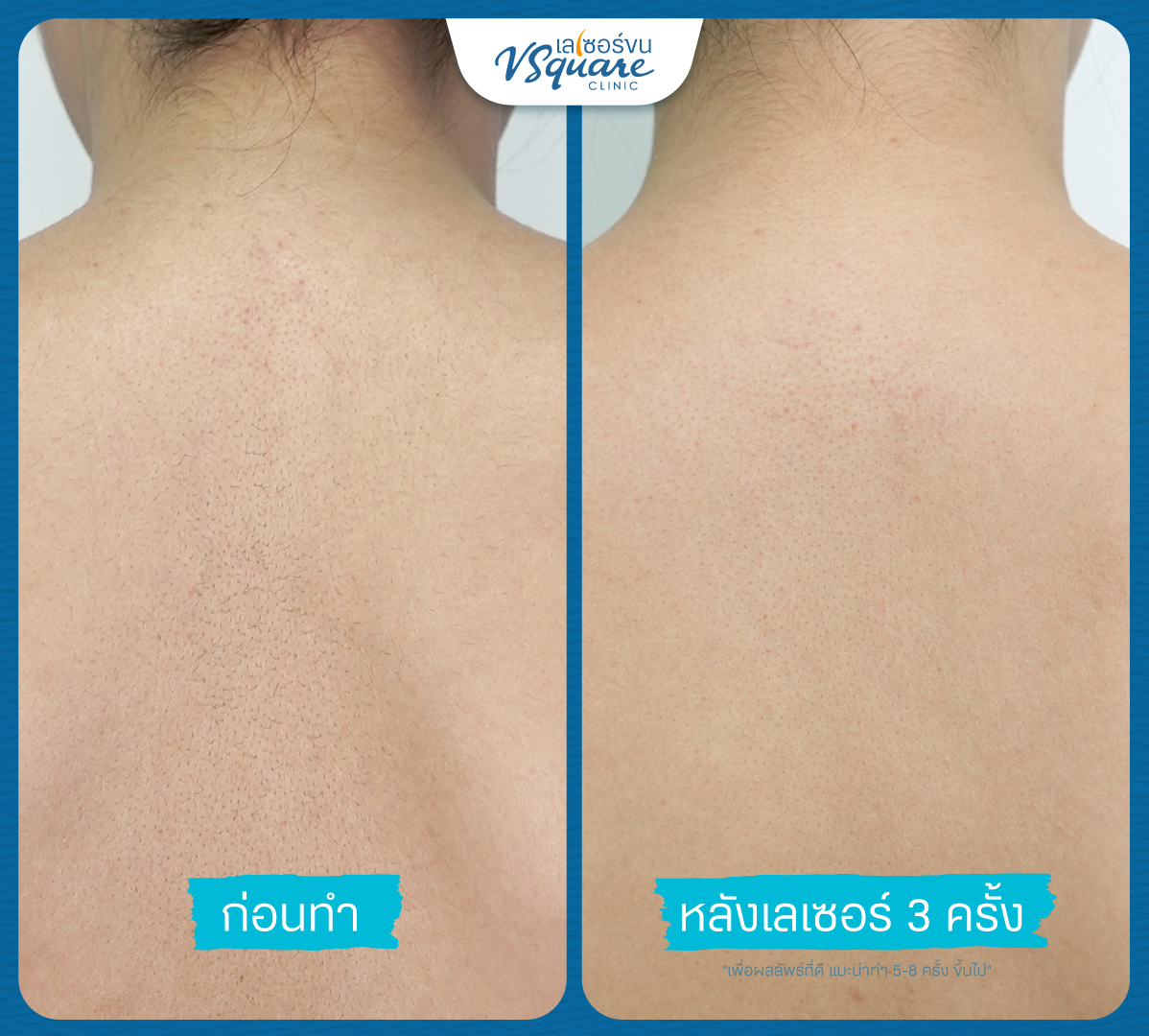 Back Laser Hair Removal Results