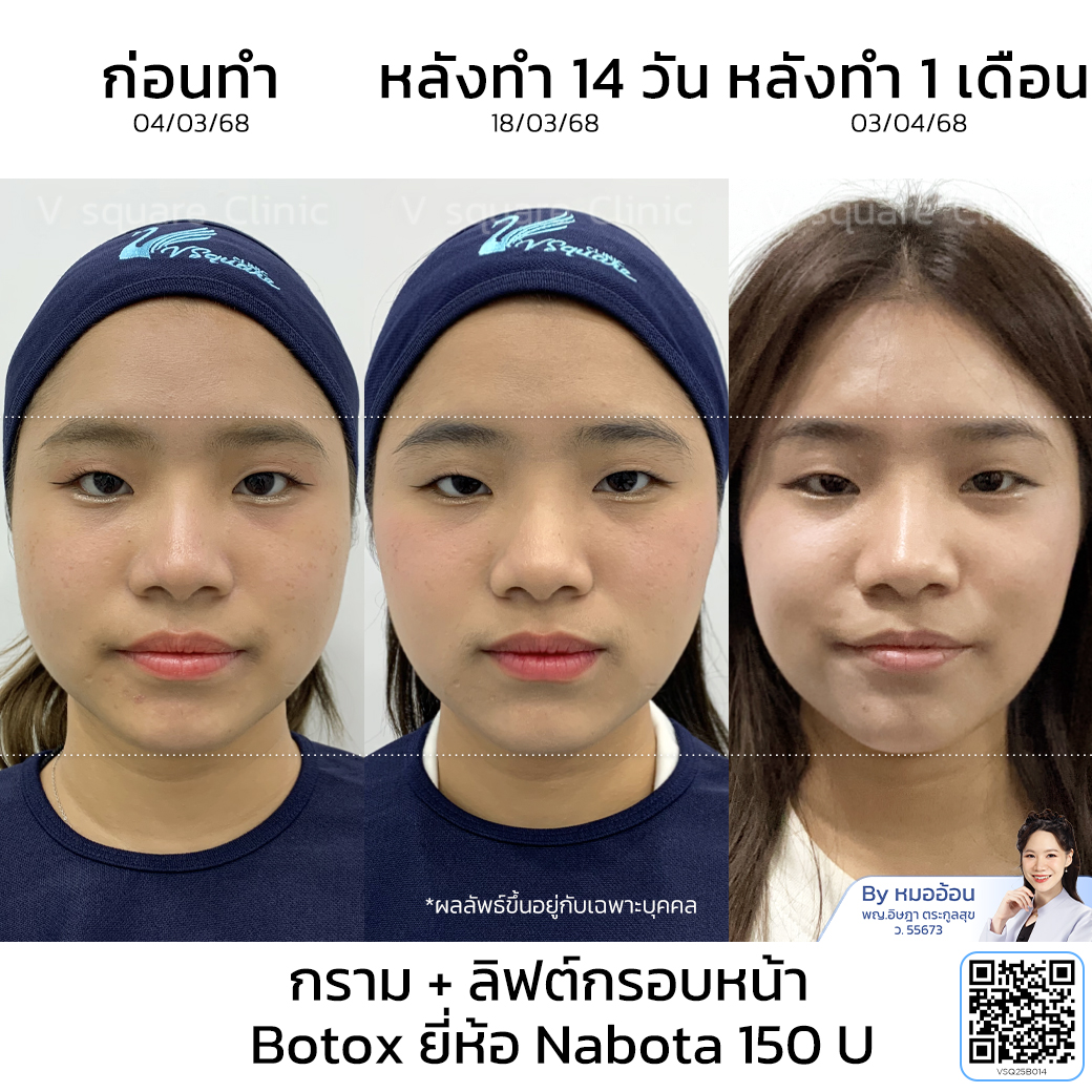 Botox masseter reduction review_คุณนิ้งค์ โดย หมออ้อน