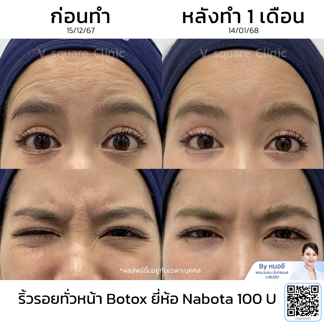 Botox wrinkle treatment review_คุณกุ๊กกิ๊ก by หมอซี