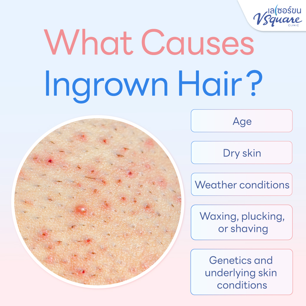 Causes of ingrown hair