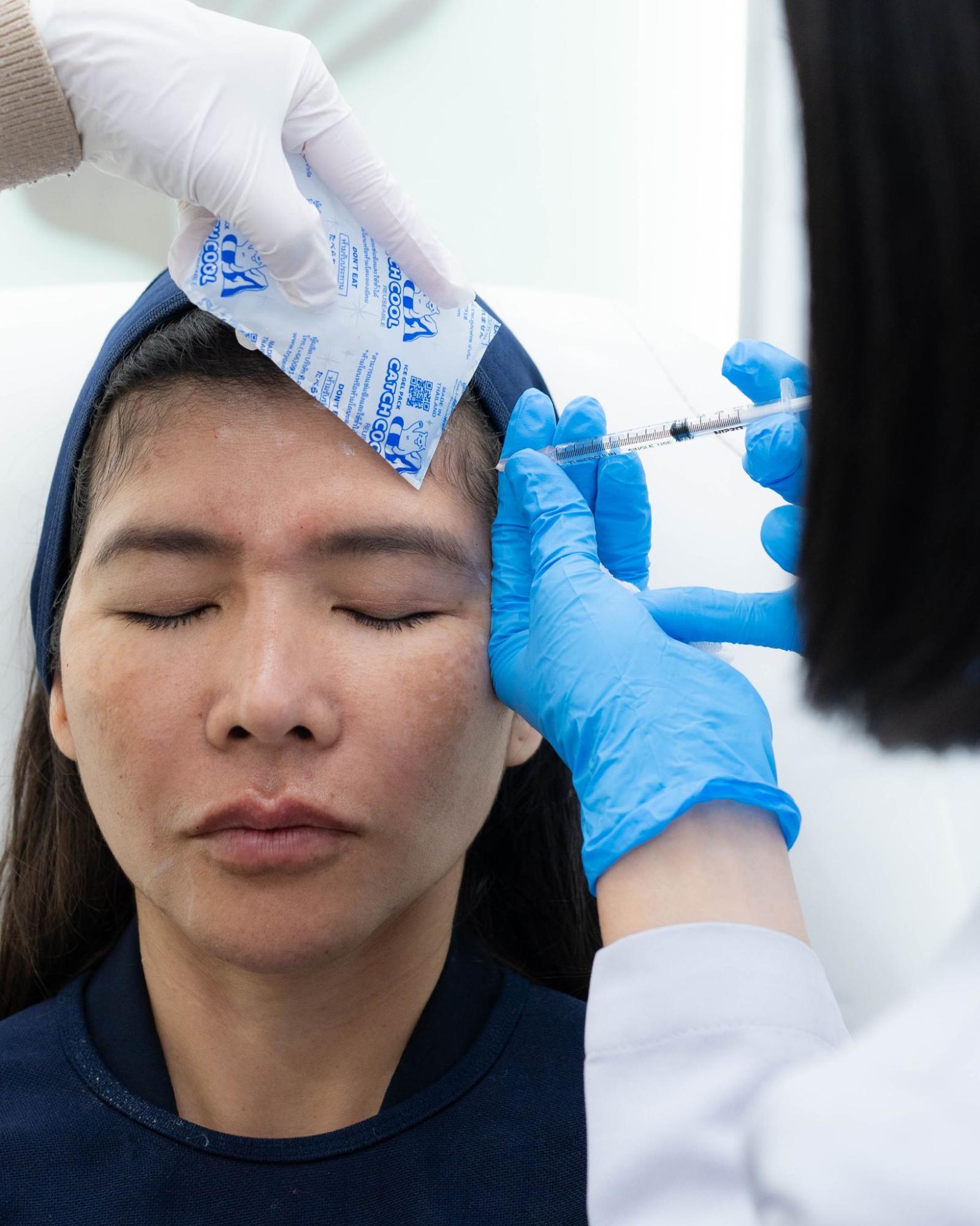 Cold compression before INBO Botox injection