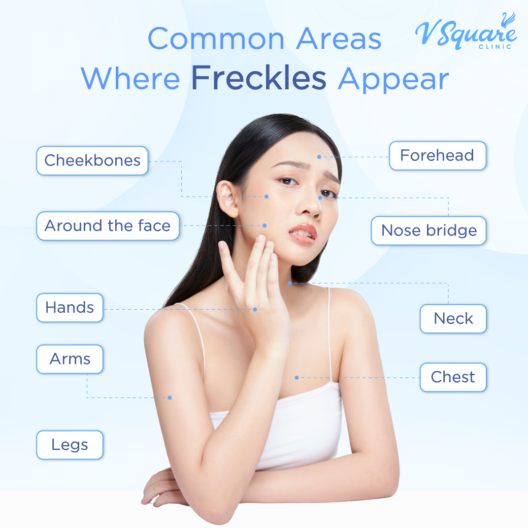 Common areas where freckles appear