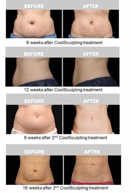 CoolSculpting review