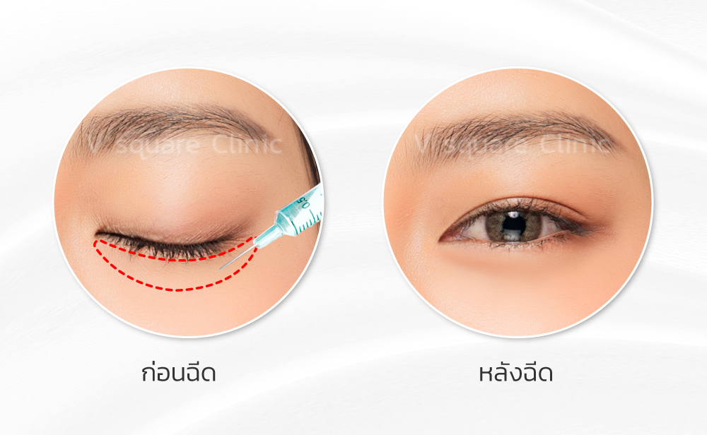 Dolly Eyes injection near the lower lash line