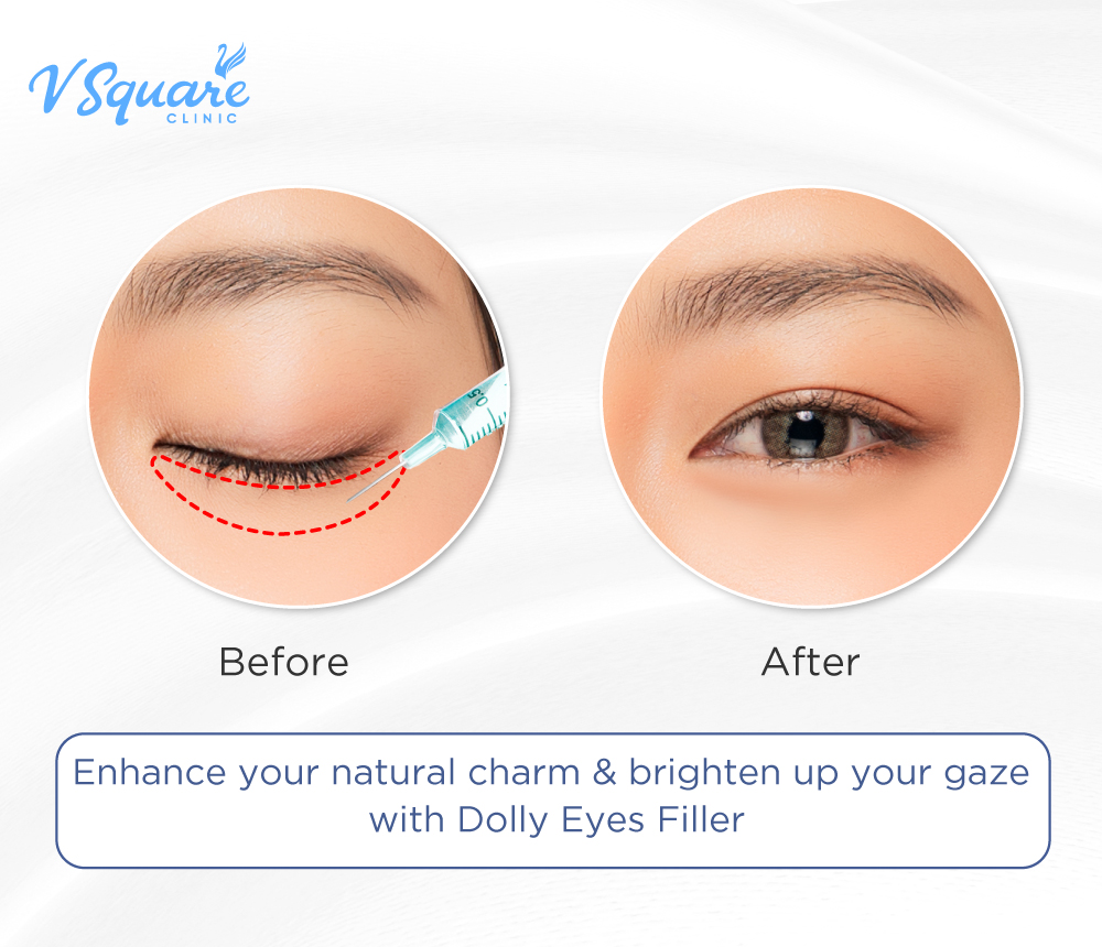 Dolly Eyes injection