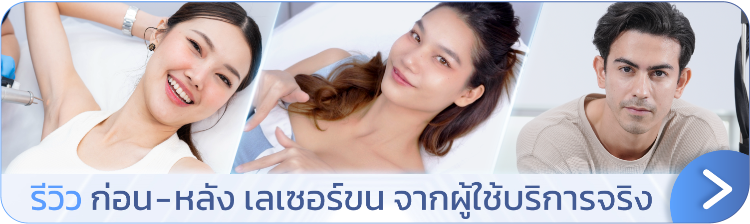 Facial laser hair removal review