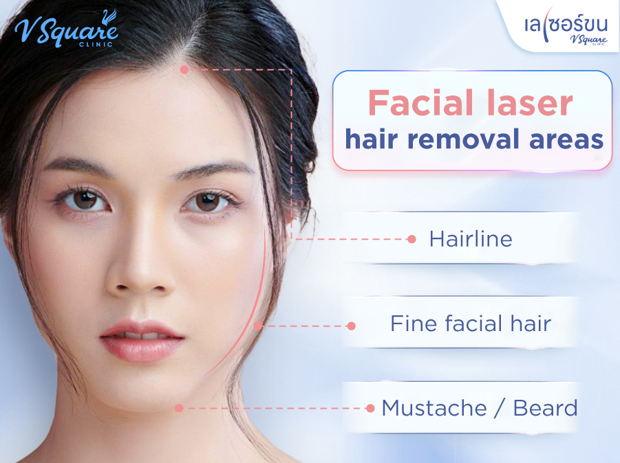 Facial laser hair removal treatment areas