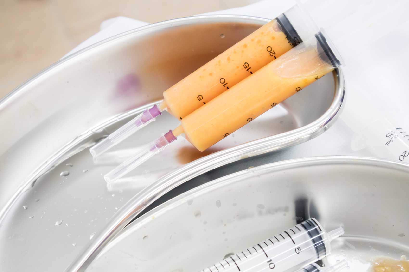 Fat grafting for Dolly Eyes