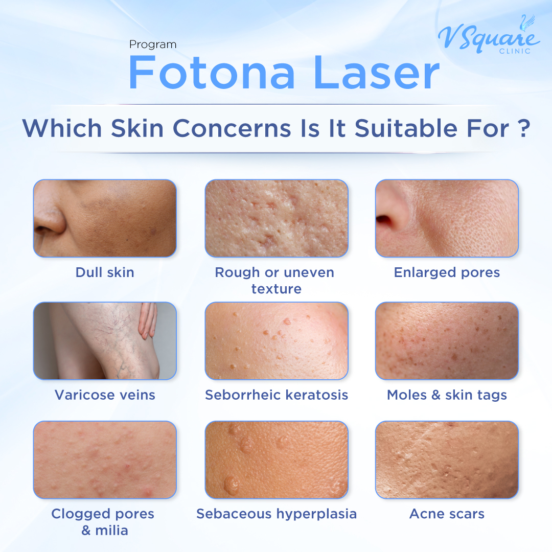 Fotona SP Dynamis suitability