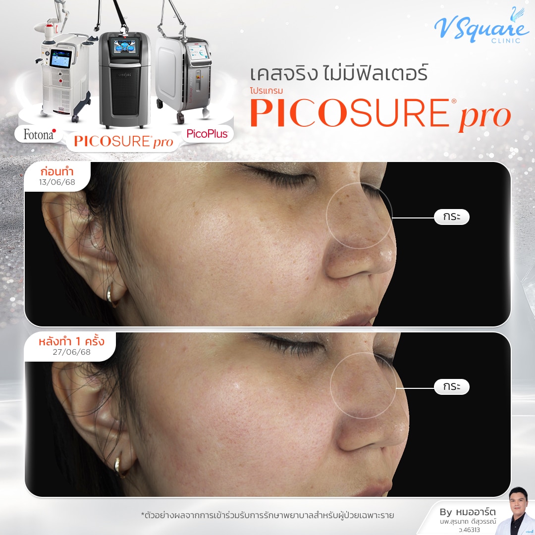 Freckle laser review Picosure Pro_คุณเป็ก by หมอ อาร์ต