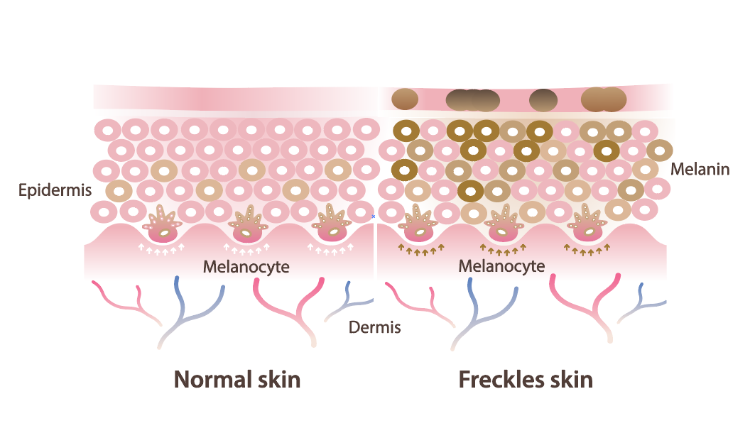 Freckled skin