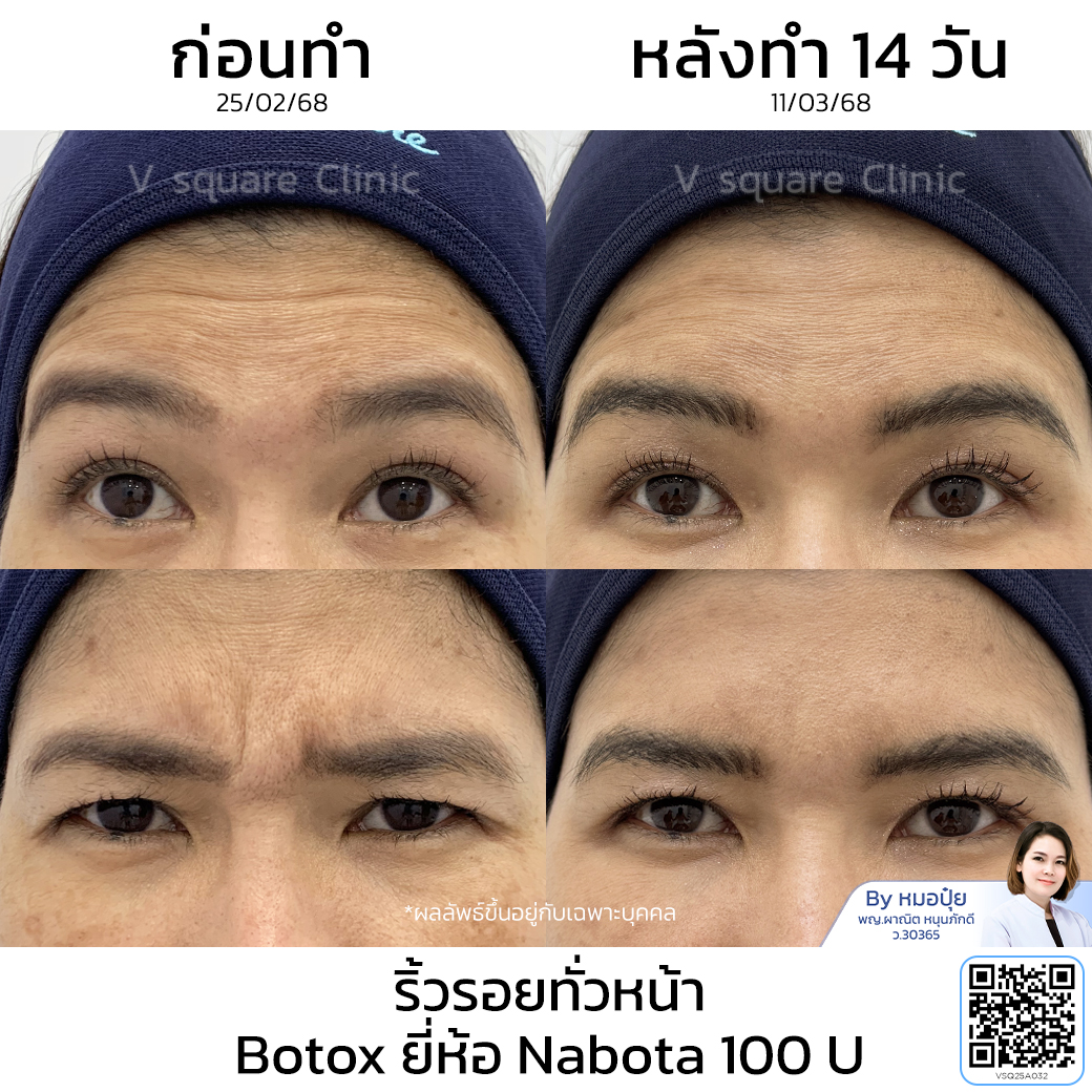 Full-face Botox wrinkle reduction review_คุณหมวย โดย หมอ ปุ๋ย