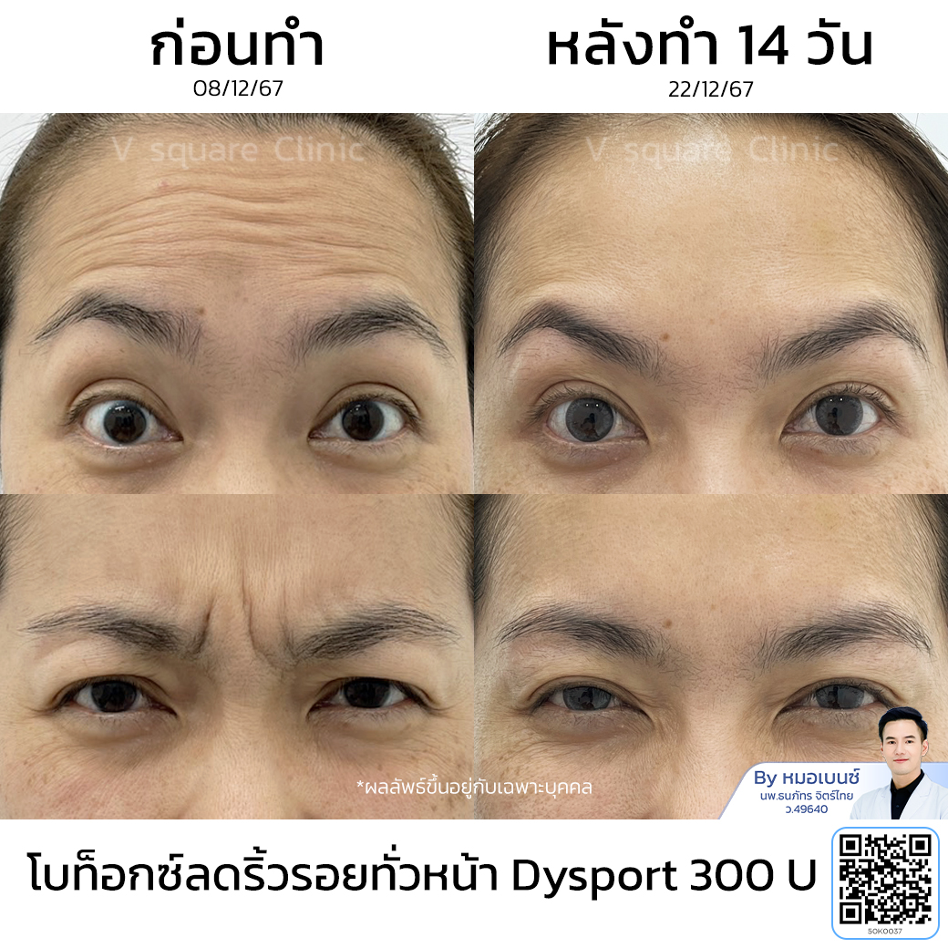 Full-face Botox wrinkle reduction review_จุฑามาศ ปวนโต โดย หมอเบนซ์