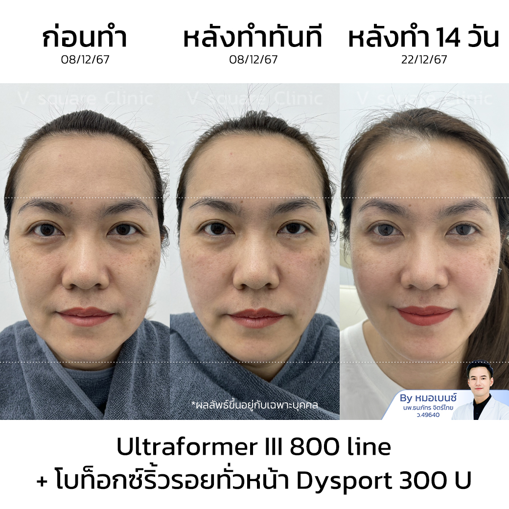 HIFU Review_จุฑามาศ ปวนโต โดย หมอเบนซ์