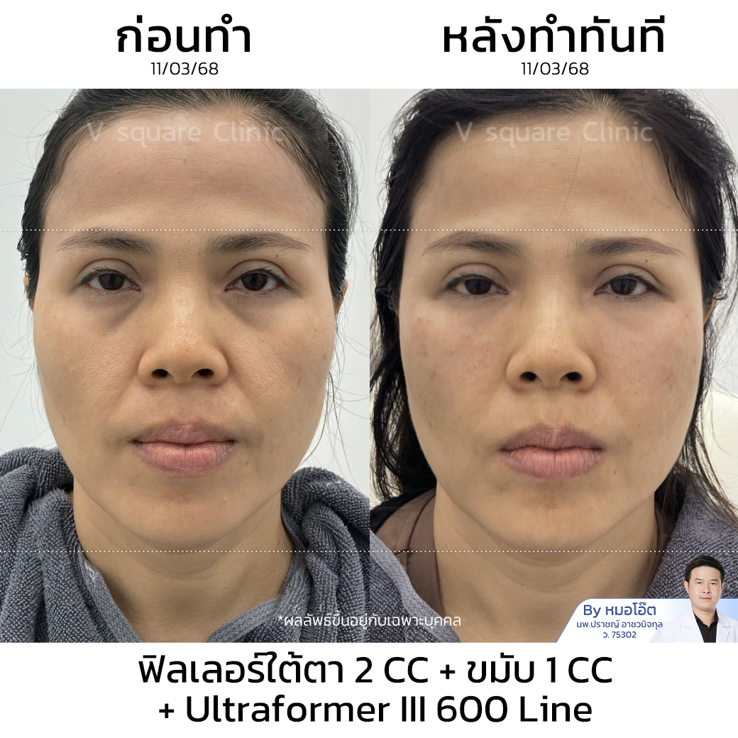 HIFU Review_บุษรา ไก่แก้ว โดย หมอโอ๊ต