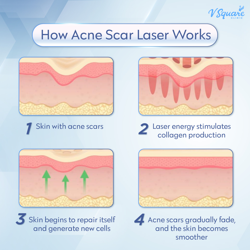 How Pico Laser for Acne Scars Works