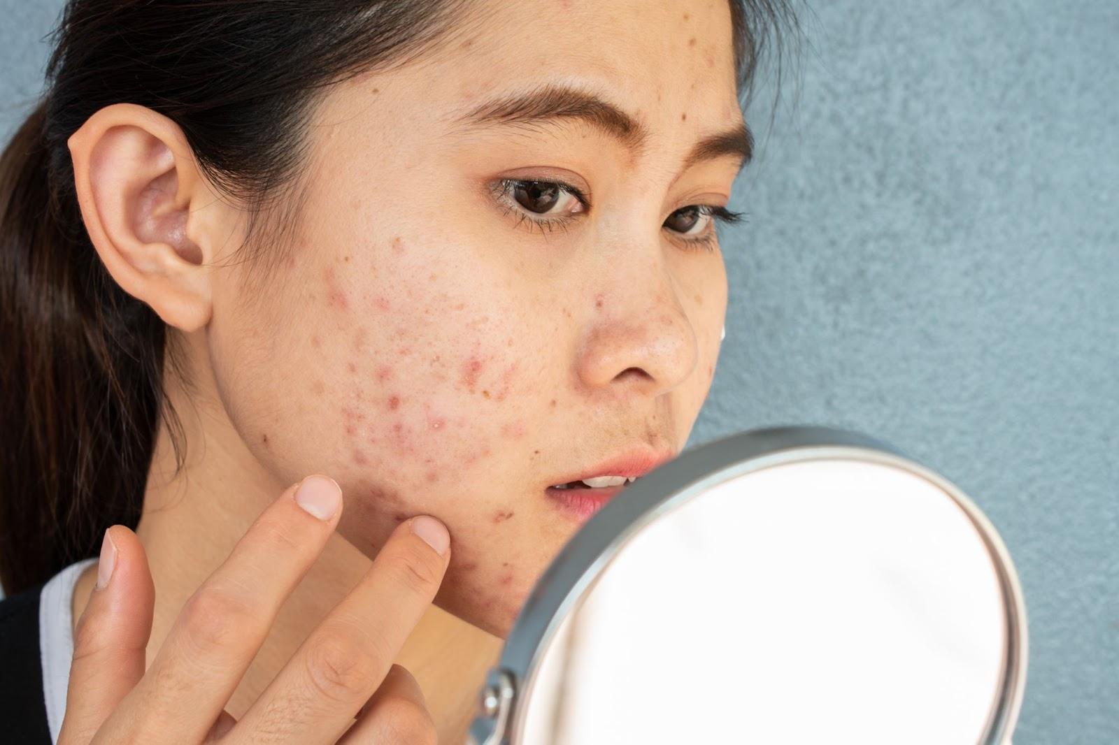 How acne scars develop
