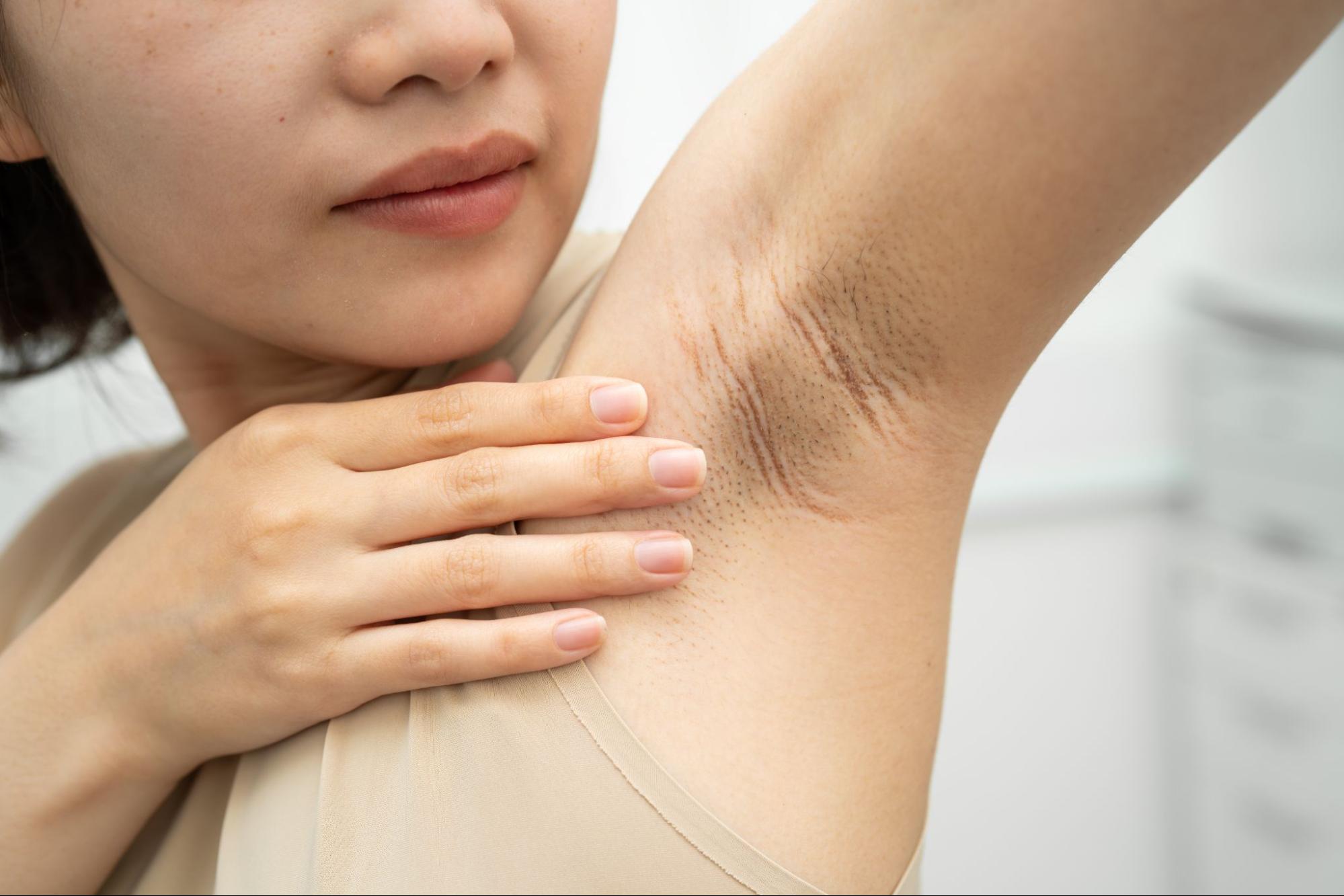 Keratosis pilaris underarms