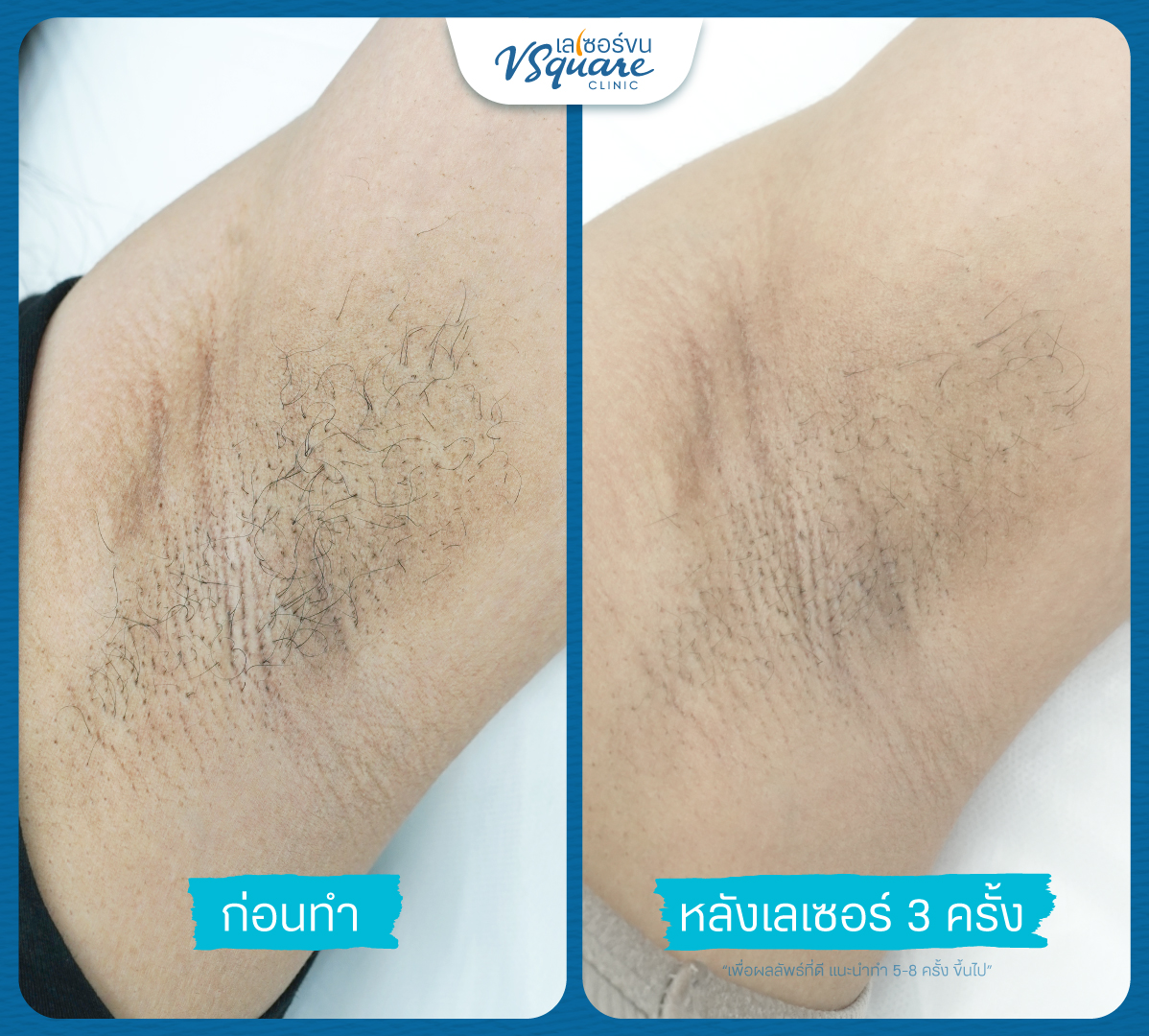 Laser Hair Removal Review