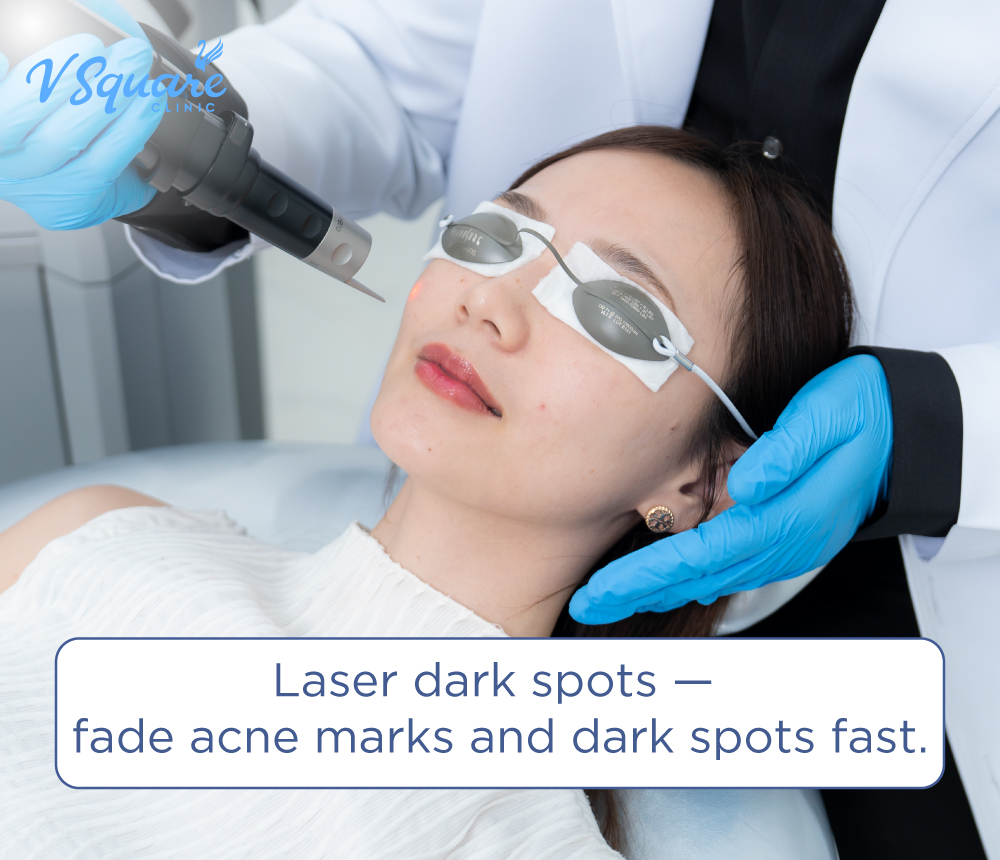 Laser dark spots
