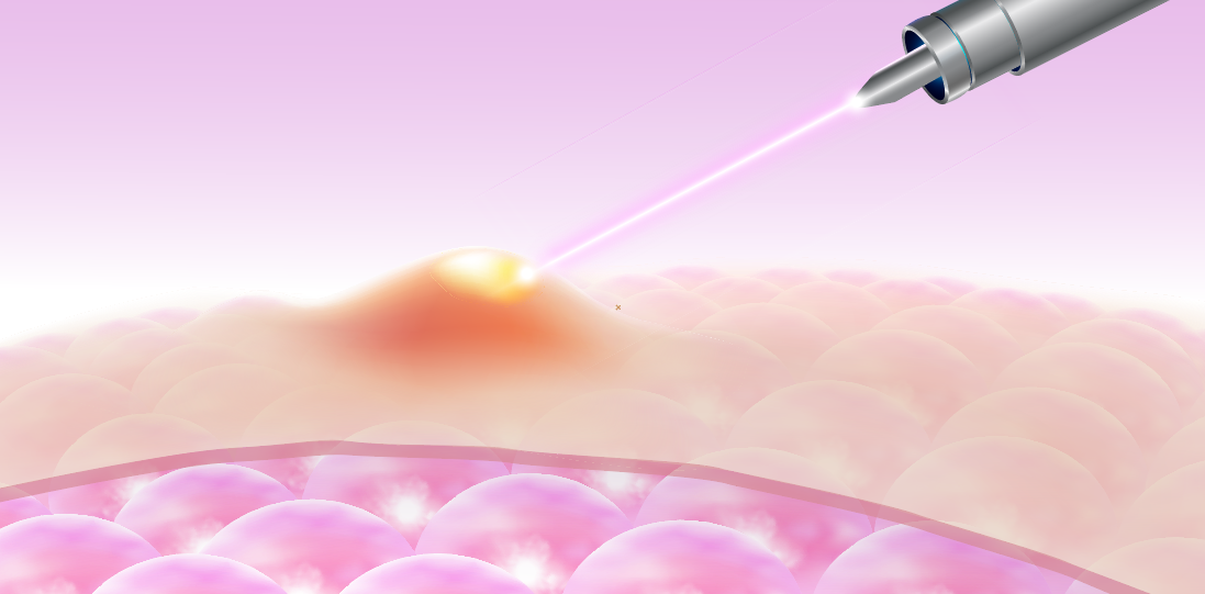 Laser for comedonal acne