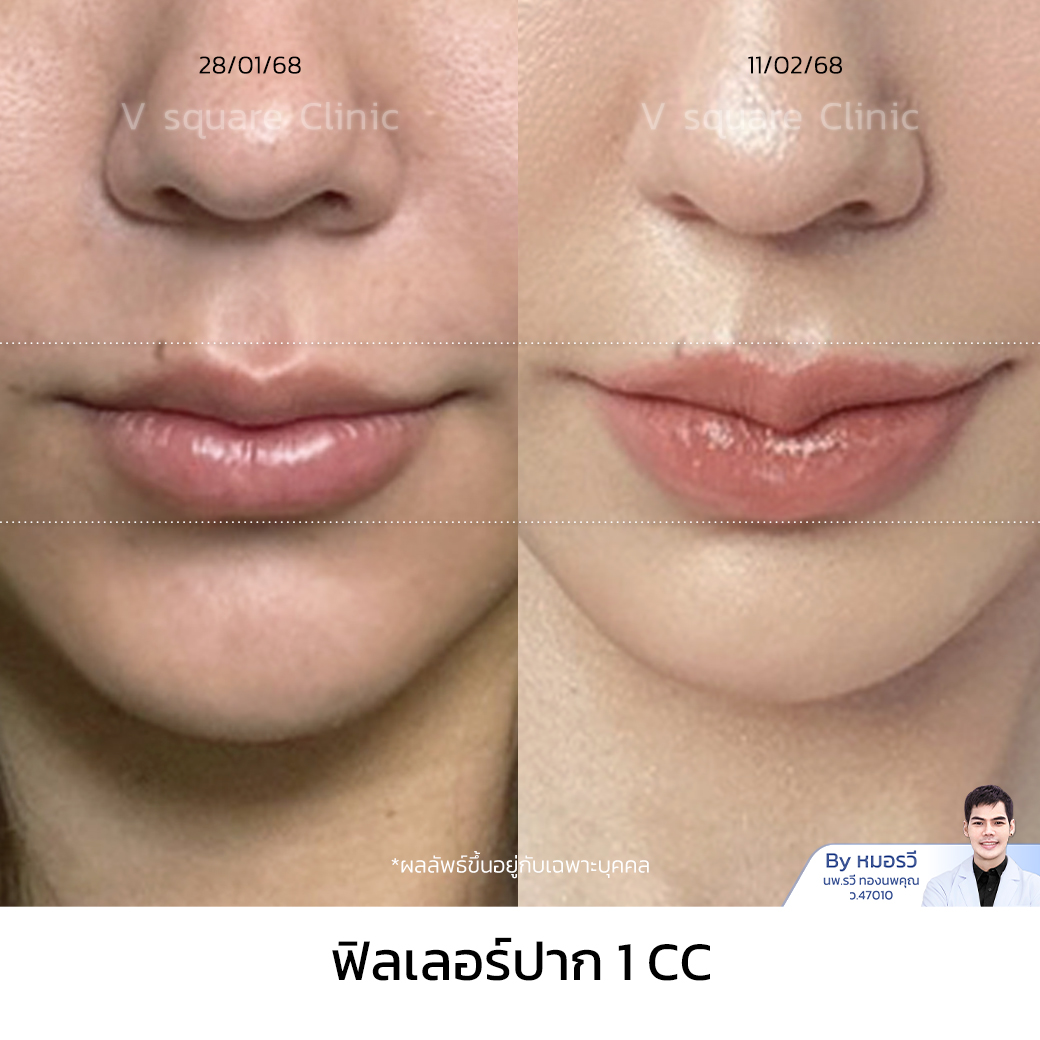 Lip filler review_เอมี่ by หมอรวี