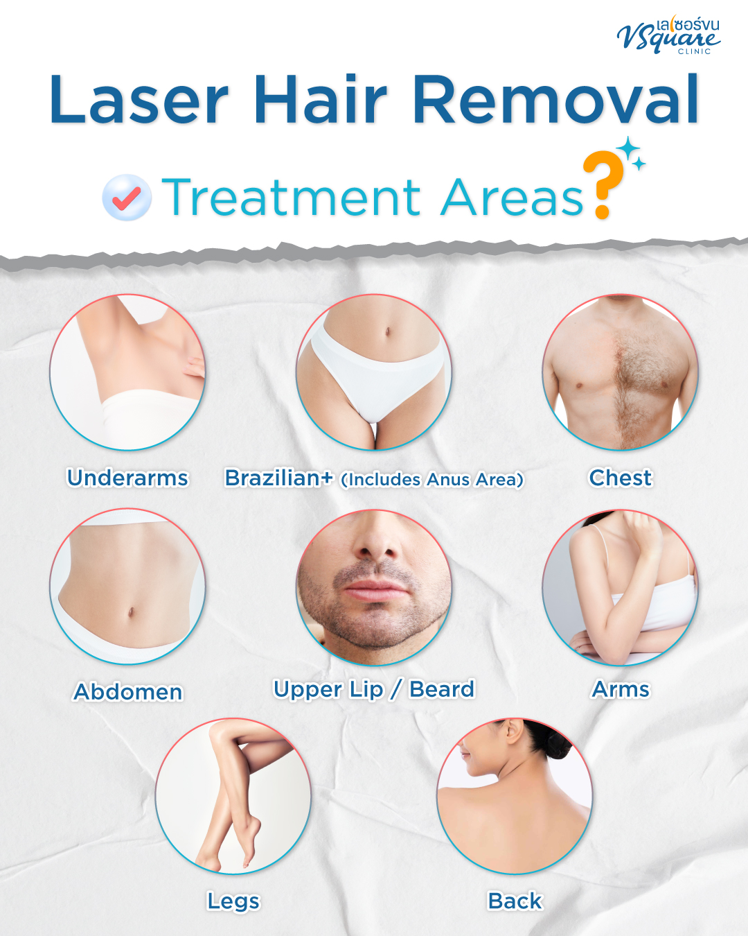 Long Pulse Nd:YAG treatment areas