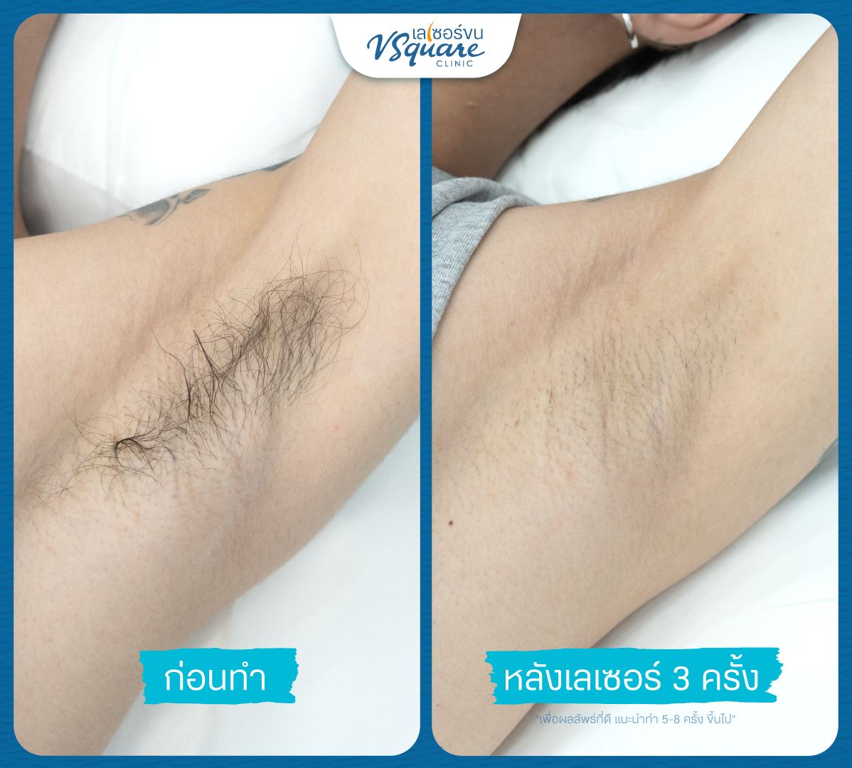 Men’s underarm hair removal review