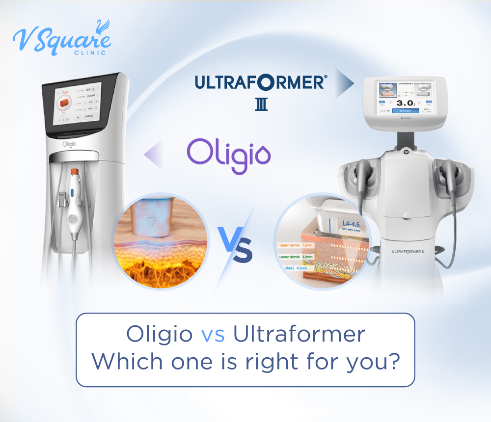 Oligio vs Ultraformer