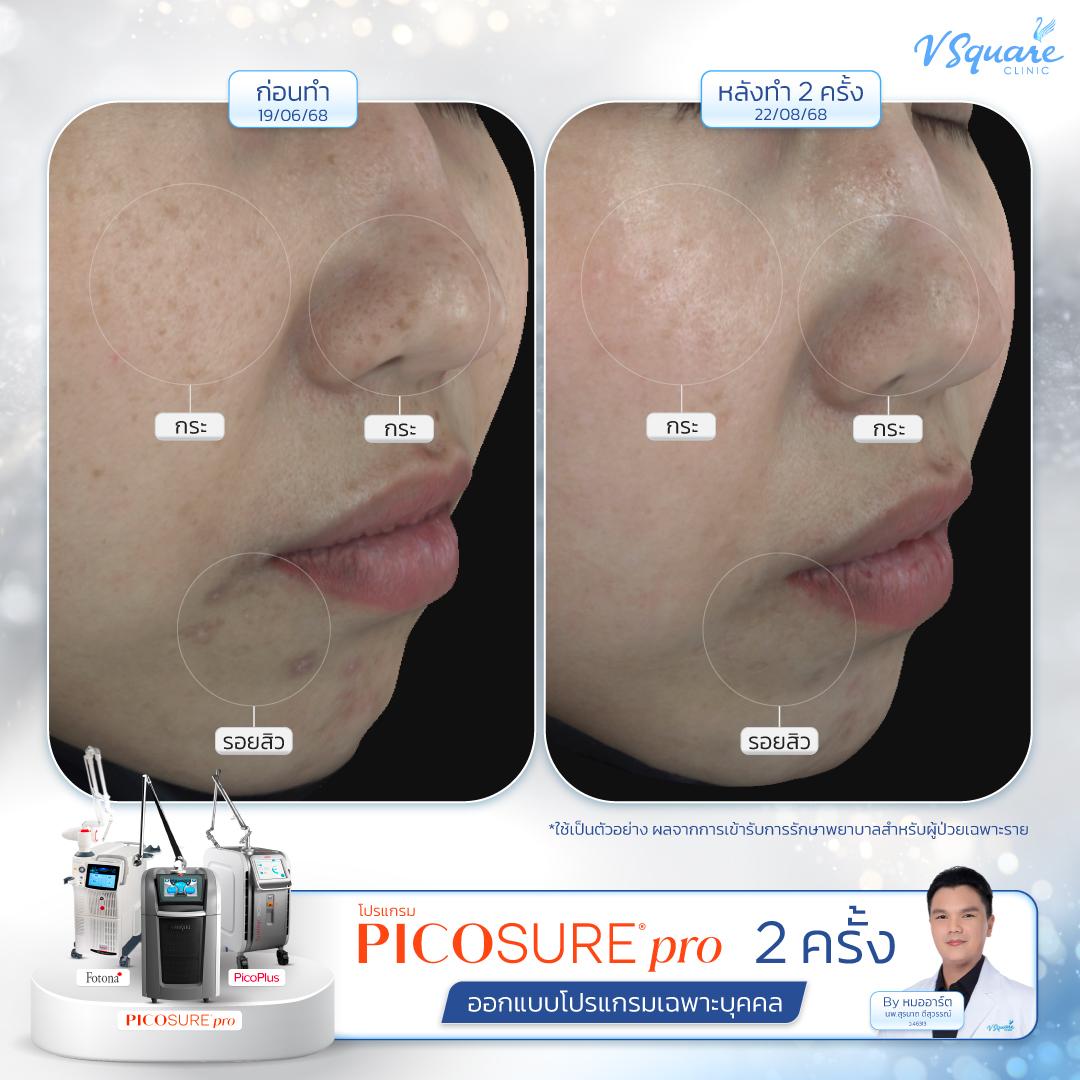 Pico Laser before–after โดย หมอ อาร์ต