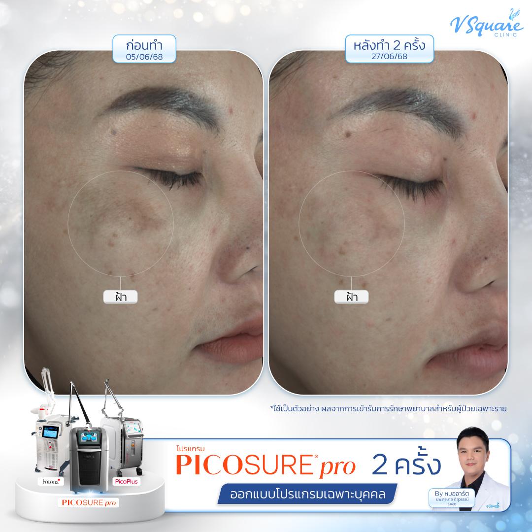 Pico Laser before–after โดย หมอ อาร์ต
