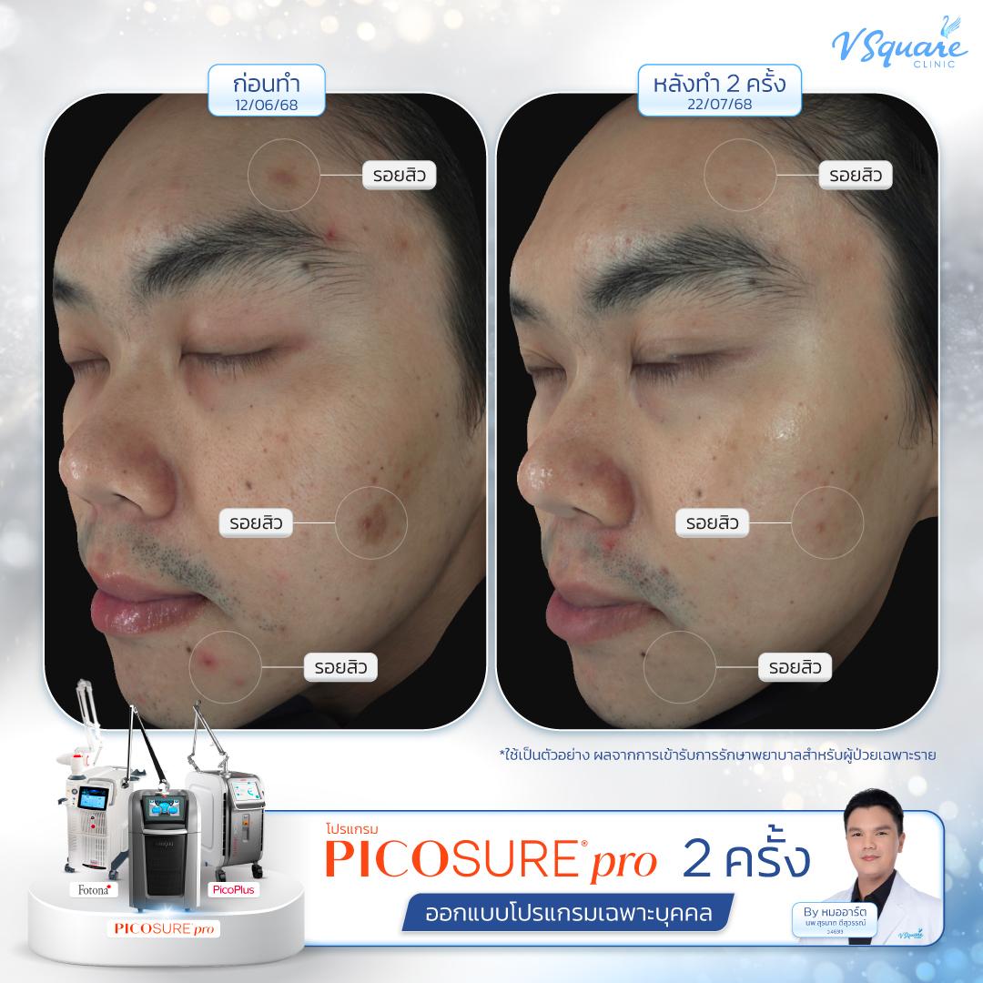Pico Laser before–after โดย หมอ อาร์ต