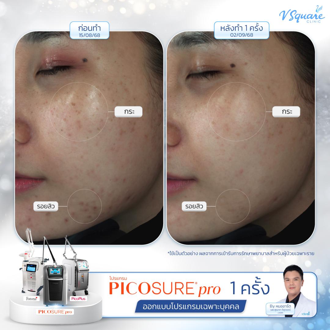 Pico Laser before–after โดย หมอ อาร์ต