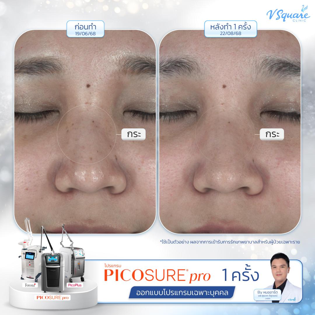 Pico Laser before–after โดย หมอ อาร์ต