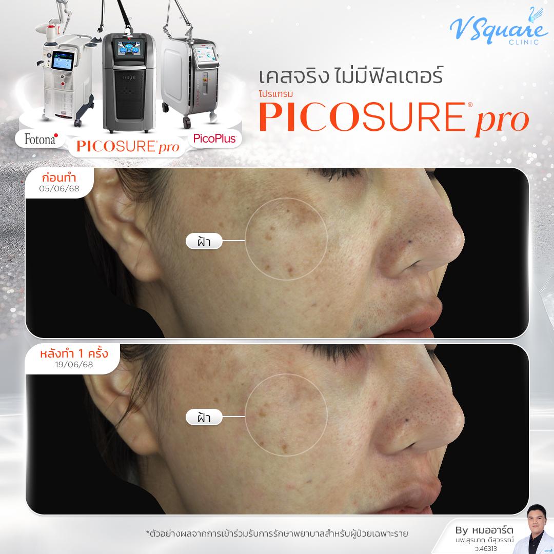 Pico Laser before–after โดย หมอ อาร์ต