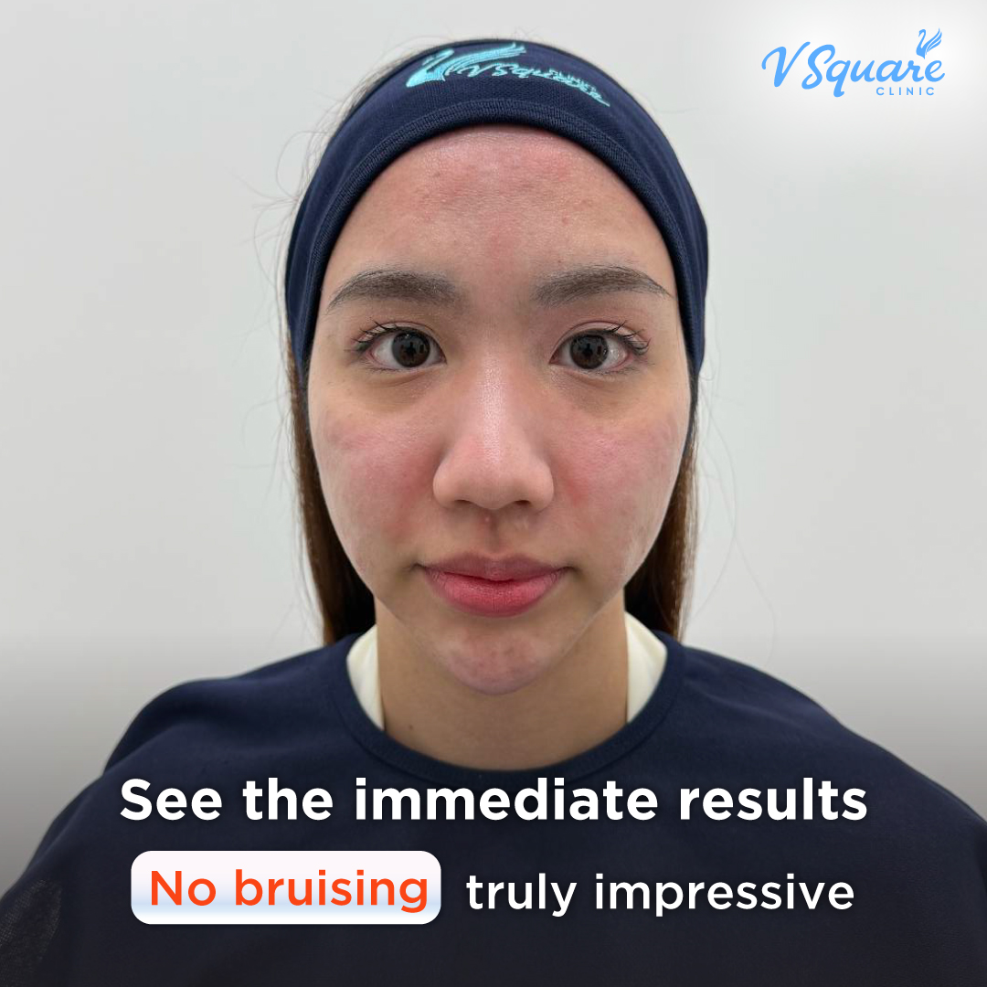 Pico Laser review after treatment