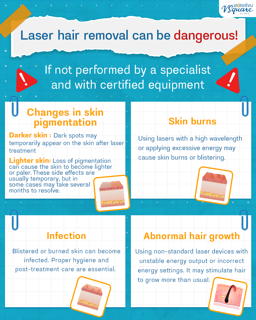 Precautions of Back Laser Hair Removal