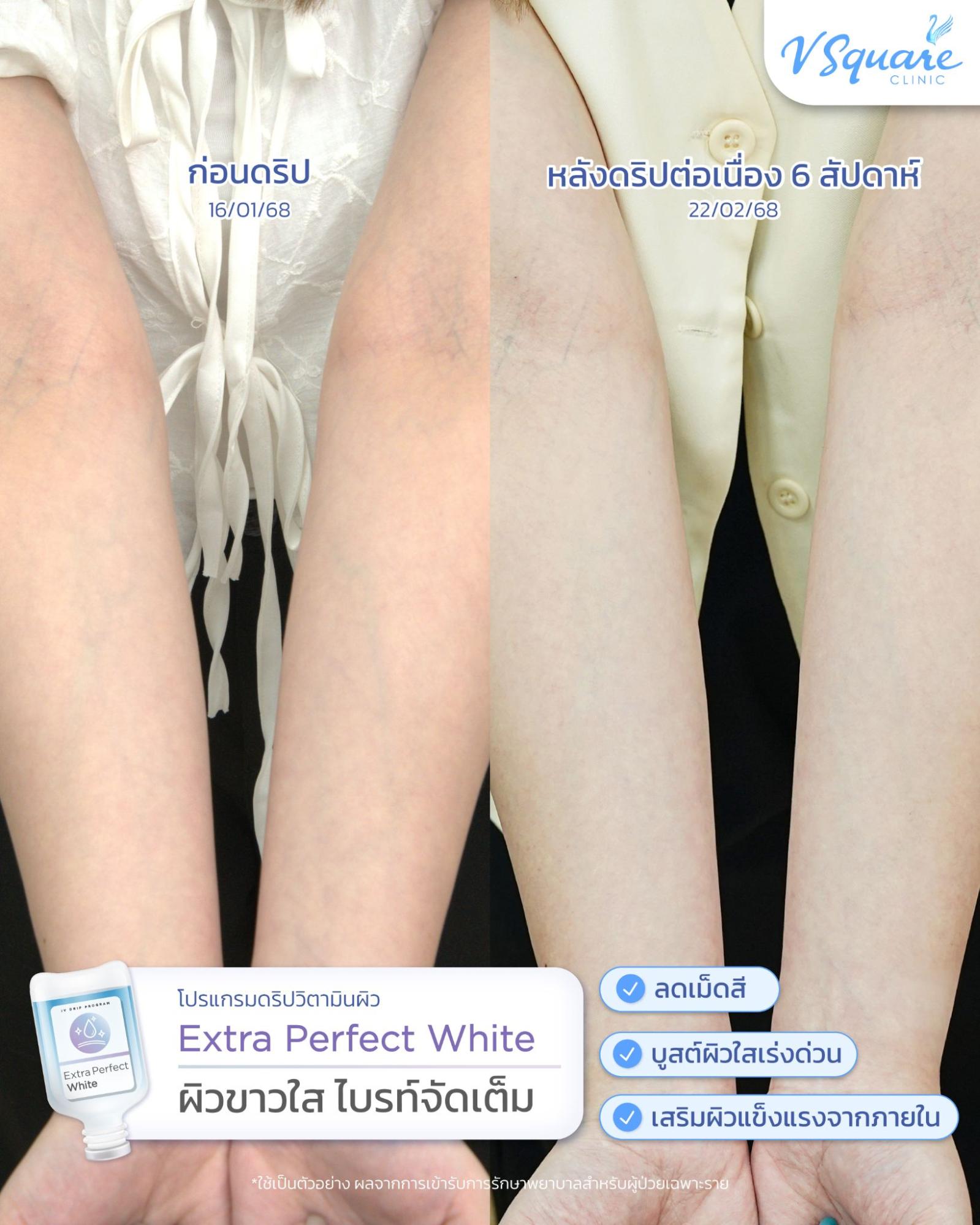 Review IV drip at v square clinic