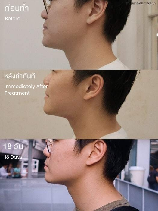 Review of Hifu Results
