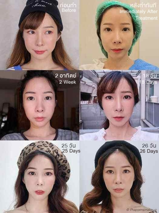 Review of Hifu results