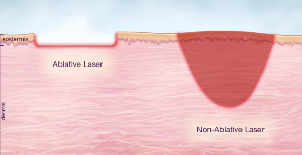 Scar removal laser treatment