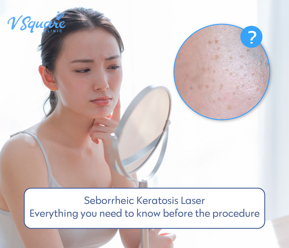 Seborrheic Keratosis Laser Treatment