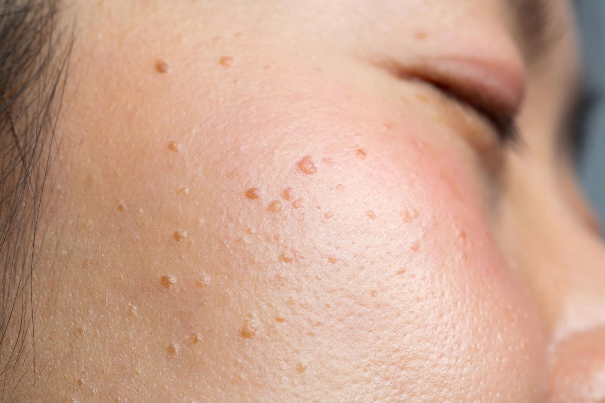 Seborrheic keratosis