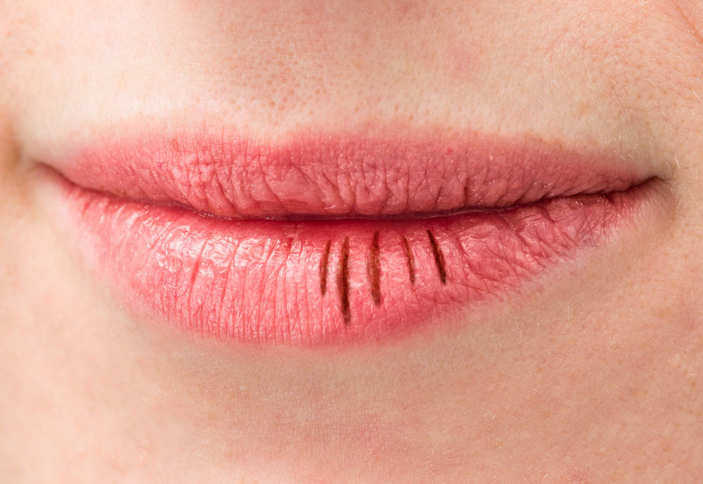 Severely dry, cracked lips with visible lip lines