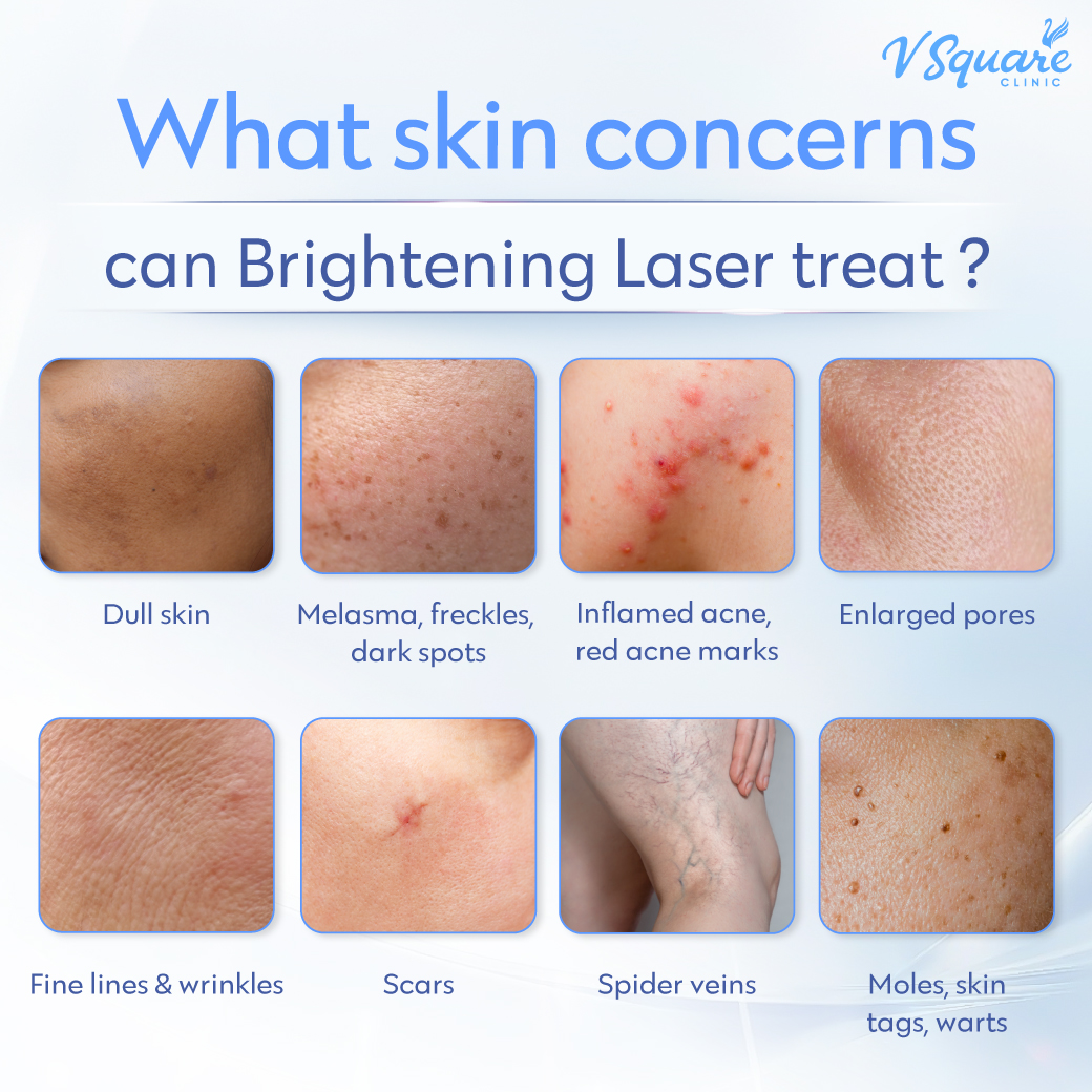 Skin Brightening laser