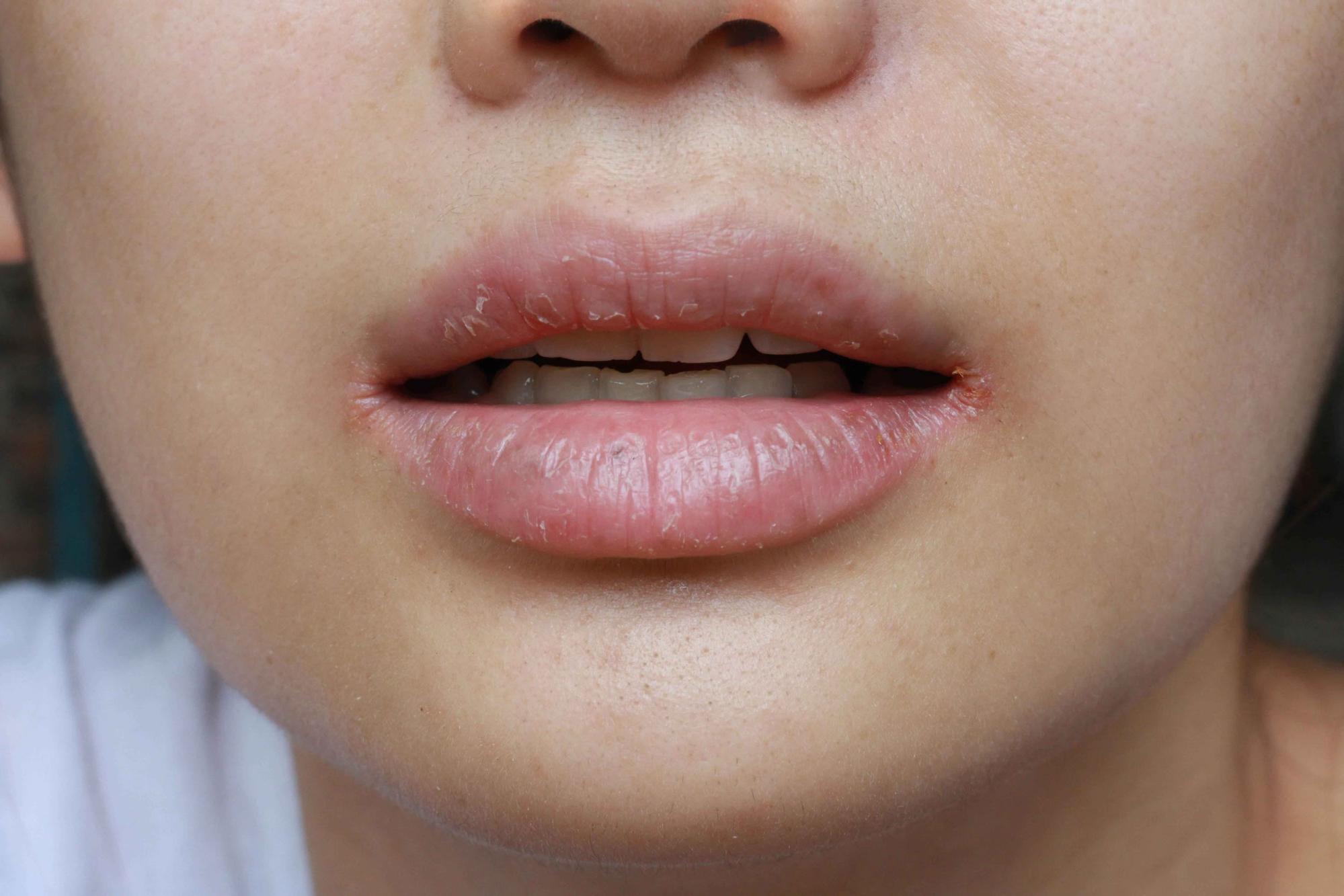 Symptoms of chapped lips